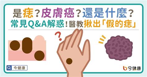 乳頭長痣|是痣or皮膚癌？醫「1張圖秒對照」 長這2部位最危險